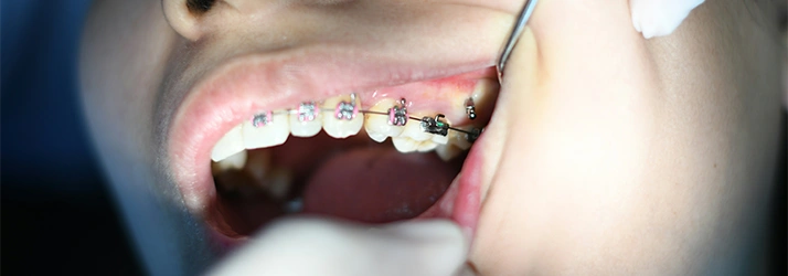 FC – Orthodontic Treatment at All Smiles Orthodontics